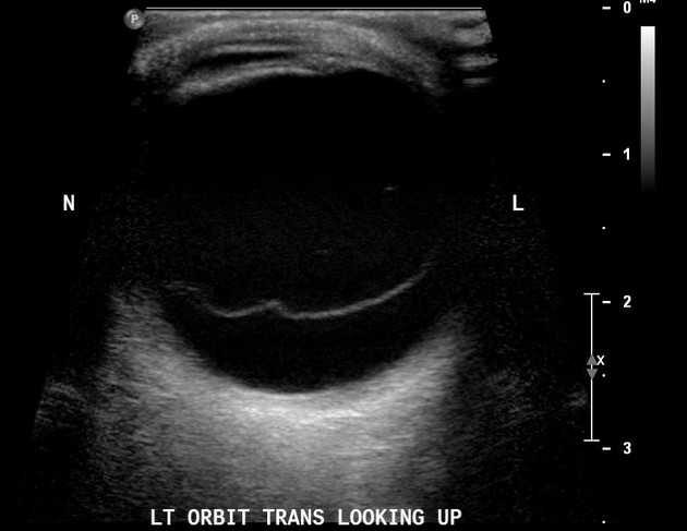 Posterior vitreous detachment