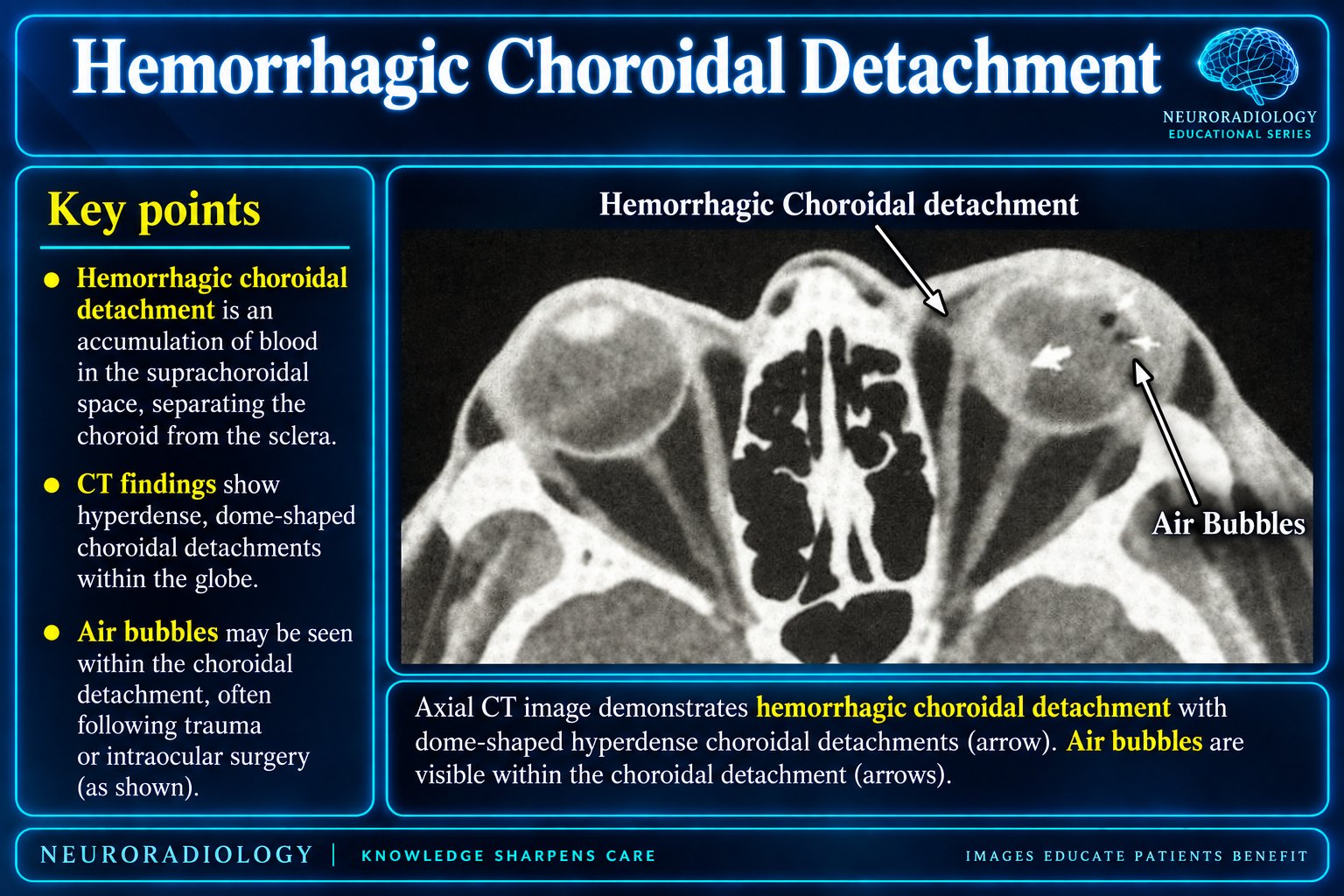 Hemorrhagic Choroidal Detachment