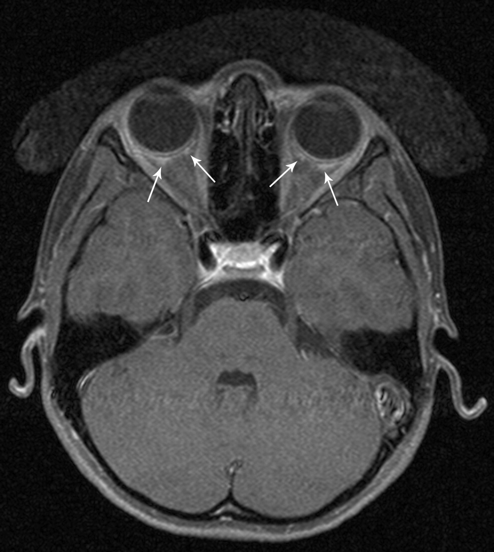 Bilateral Scleritis

Bilateral scleral and peribulbar enhancement.