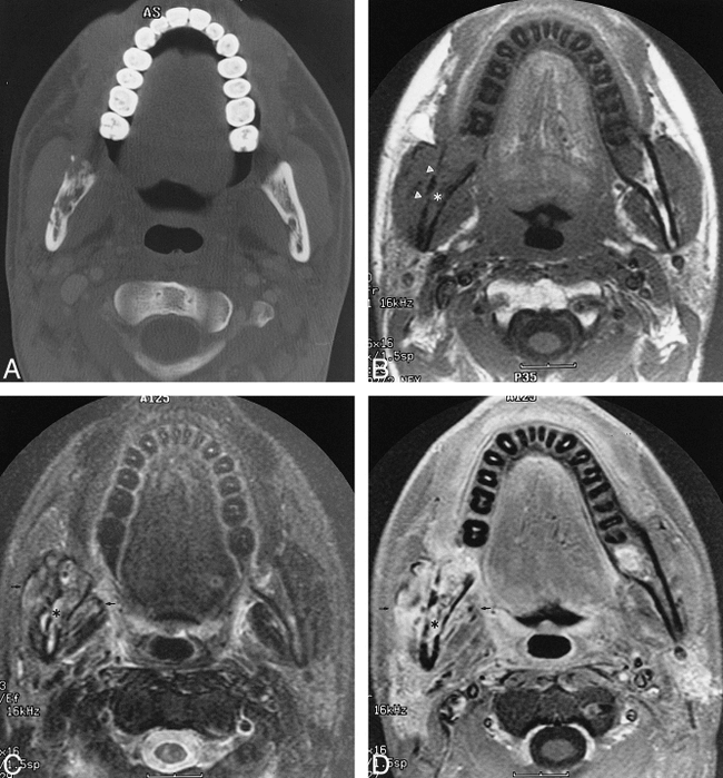7-year-old male patient who underwent radiation for left-sided poorly differentiated squamous cell carcinoma of the nasopharynx.

A, Axial CT scan (bone window) shows ORN involving the mandibular ramus contralateral to the primary tumor site with cortical disruption and trabecular disorganization.

B, Unenhanced T1-weighted (400/9 [TR/TE]) MR image shows abnormal homogeneous signal hypointensity of the bone marrow of the right mandible (asterisk) and cortical disruption (arrowheads). Note that the right masticator muscles appear slightly larger than the contralateral side.

C, Axial T2-weighted (4000/105 [TR/TEeff]) MR image shows abnormal hyperintense signal of the marrow (asterisk) and adjacent masseter and pterygoid muscles (arrows).

D, Contrast-enhanced fat-saturated T1-weighted (400/9 [TR/TE]) MR image shows diffuse intense enhancement of the marrow (asterisk) and adjacent musculature (arrows).