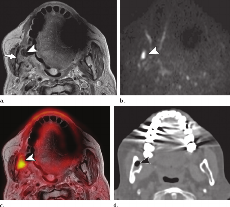 mandibular osteoradionecrosis 4 years after radiation therapy for a tonsillar SCC. Axial gadolinium-enhanced T1-weighted MR image (a) , DW image ( b = 1000 sec/mm 2 ) (b) , fused PET – gadolinium-enhanced T1-weighted MR image (c) , and CT image from hybrid PET/CT (d) show enhancement of the ascending ramus of the mandible (arrow in a ), cortical destruction and abscess formation (arrowhead in a–c ), characteristic peripheral rim enhancement, restricted diffusion, and high focal FDG uptake. Restricted diffusion is seen in the abscess, whereas increased FDG uptake is seen in the granulation tissue posterior to the abscess, as expected. Air inclusion (arrowhead in d ) is better depicted at CT than at MR imaging. Follow-up images obtained 20 months later confirmed findings of benign osteoradionecrosis.