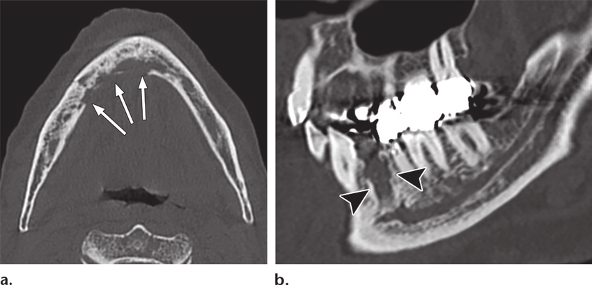 sclerotic and lytic areas in the mandible with discontinuities of the cortical bone (arrows). (b) Sagittal CT image (bone window) reveals the nonhealing socket of an extracted tooth (arrowheads).