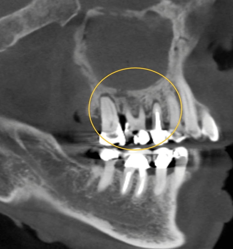 Generalized osteosclerosis with widened PDL space (yellow circle).
PDL: periodontal ligament