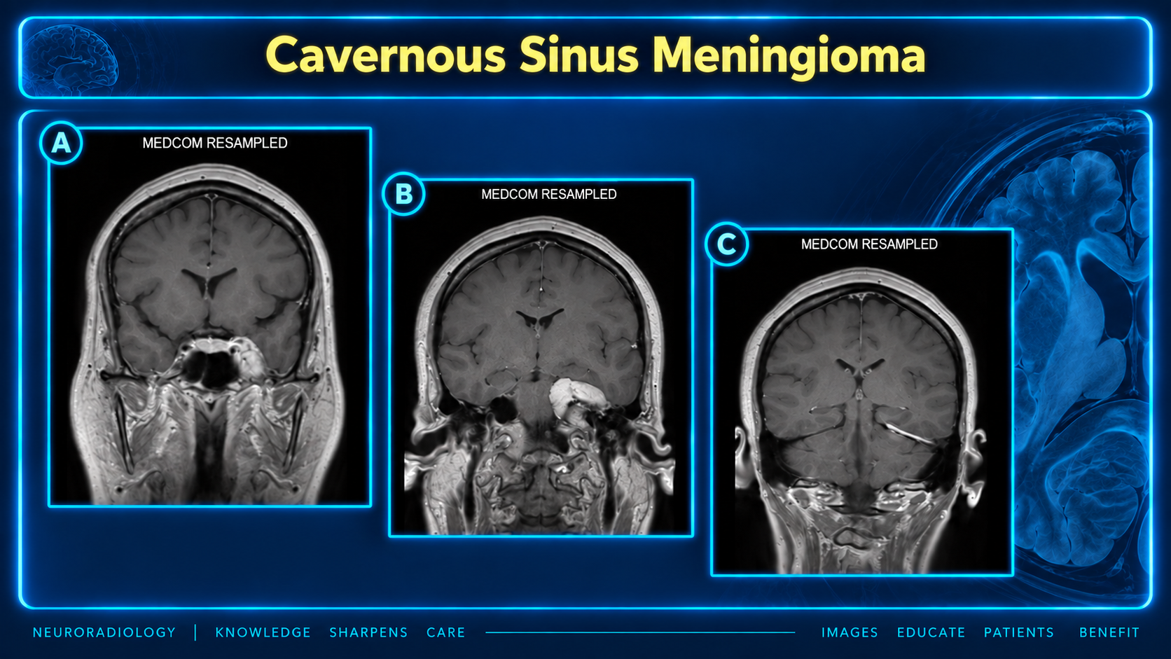 Coronal postcontrast MRI of cavernous sinus meningioma