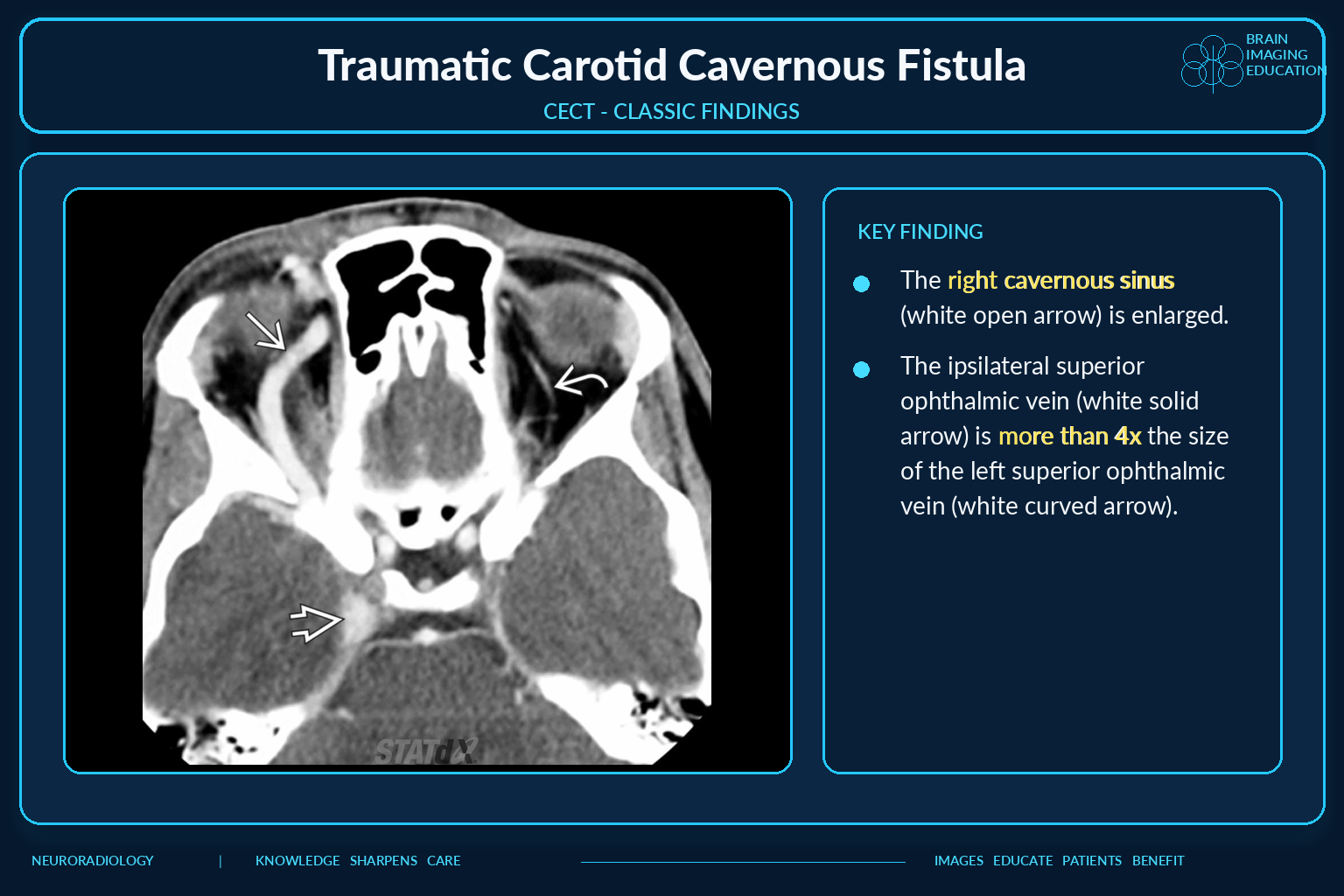 Contrast enhanced CT classic findings of CCF