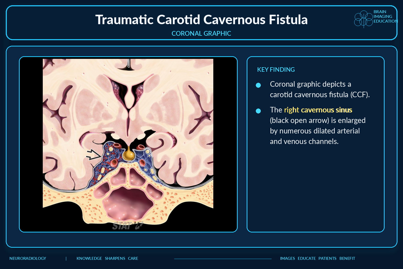 Coronal graphic of enlarged cavernous sinus in CCF