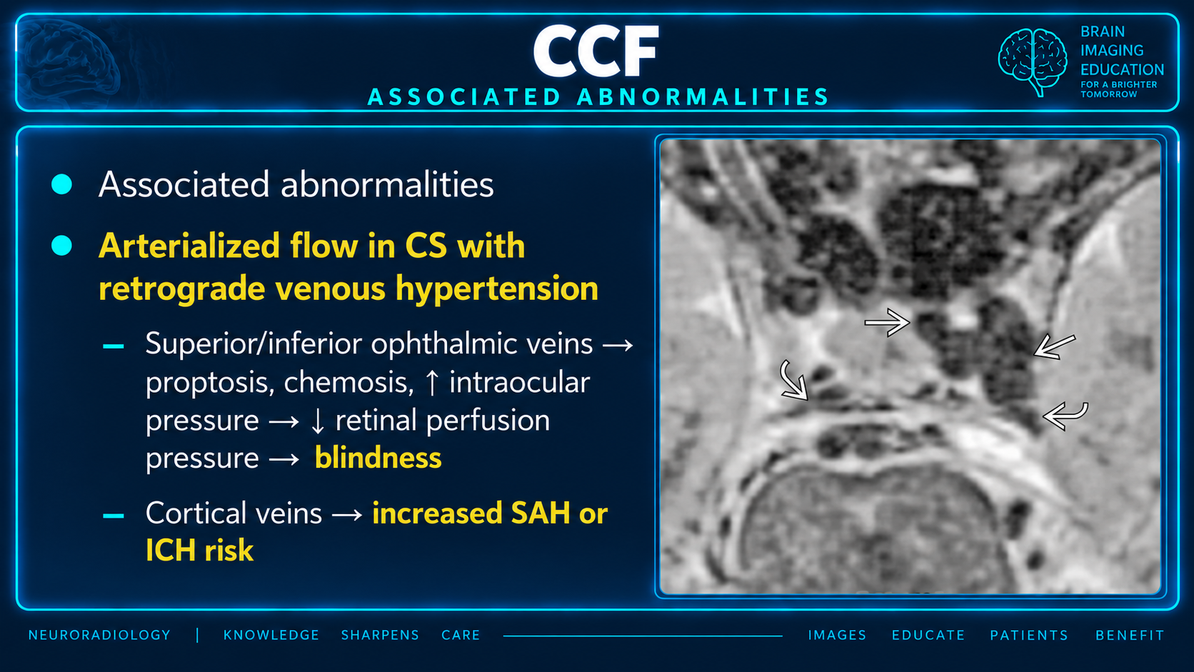 MRI findings of retrograde venous hypertension from CCF