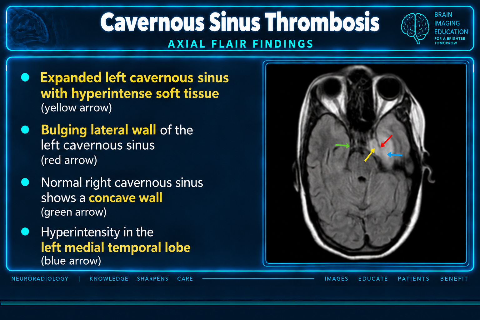 Axial FLAIR findings of cavernous sinus thrombosis