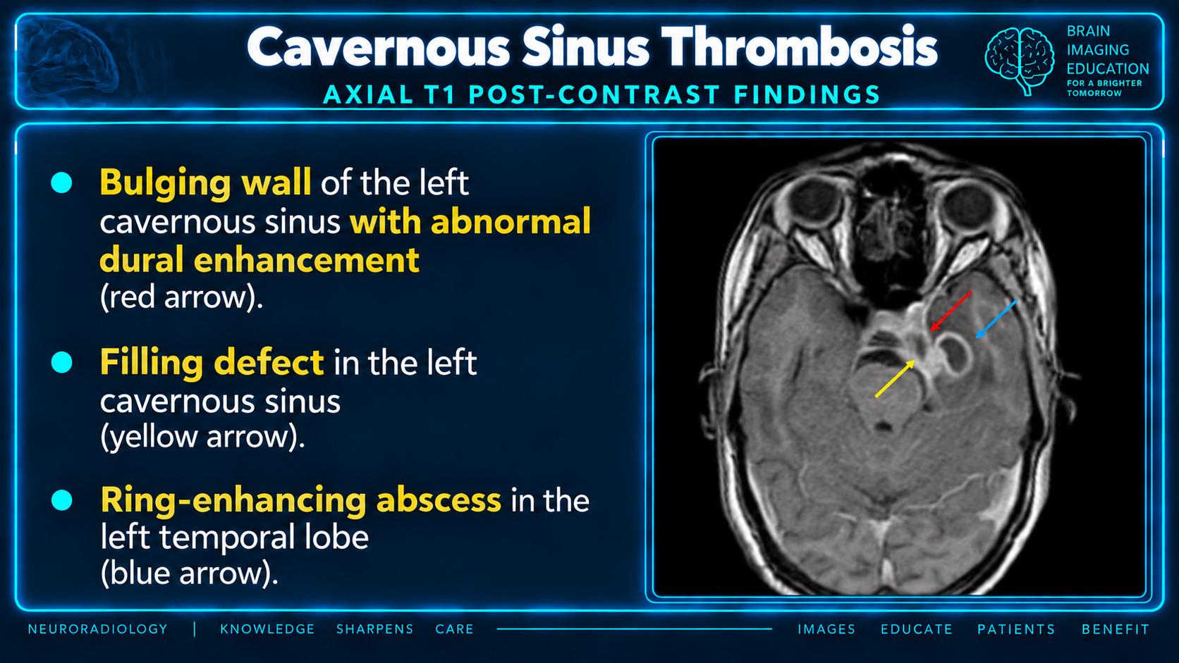 Postcontrast MRI findings and temporal lobe abscess in cavernous sinus thrombosis
