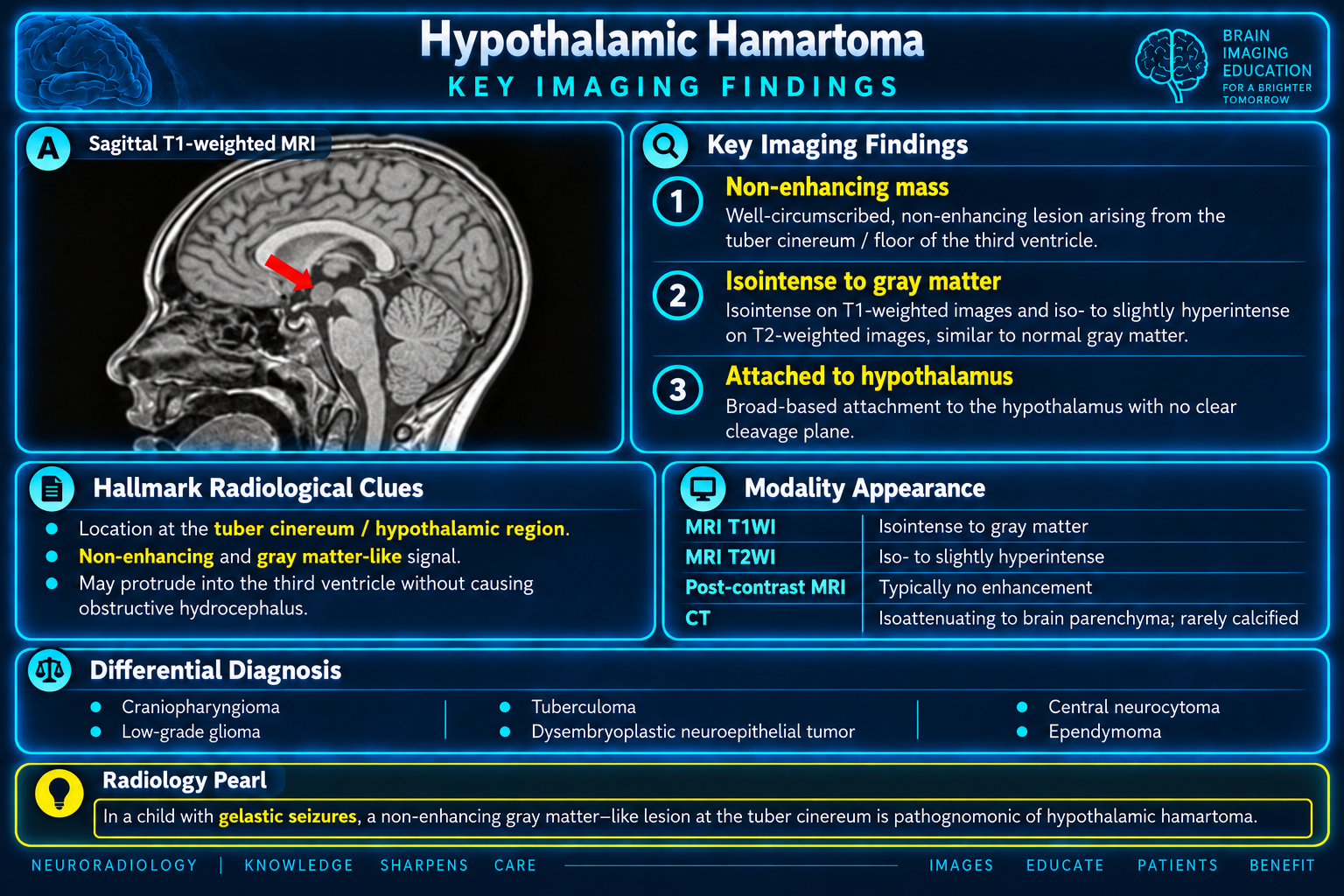 Hypothalamic hamartoma key MRI findings and differential diagnosis