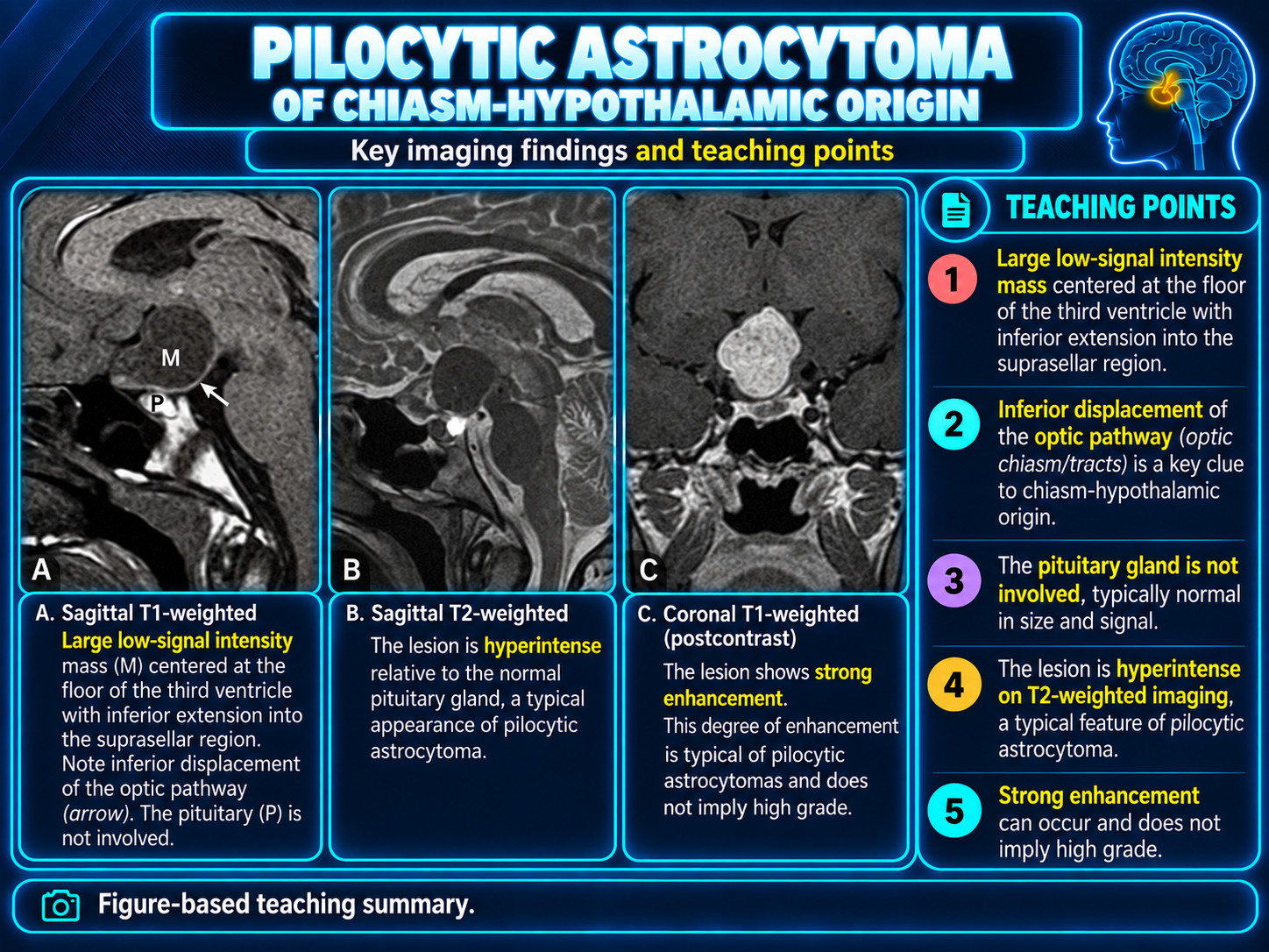 Pilocytic astrocytoma of chiasmatic hypothalamic origin on MRI