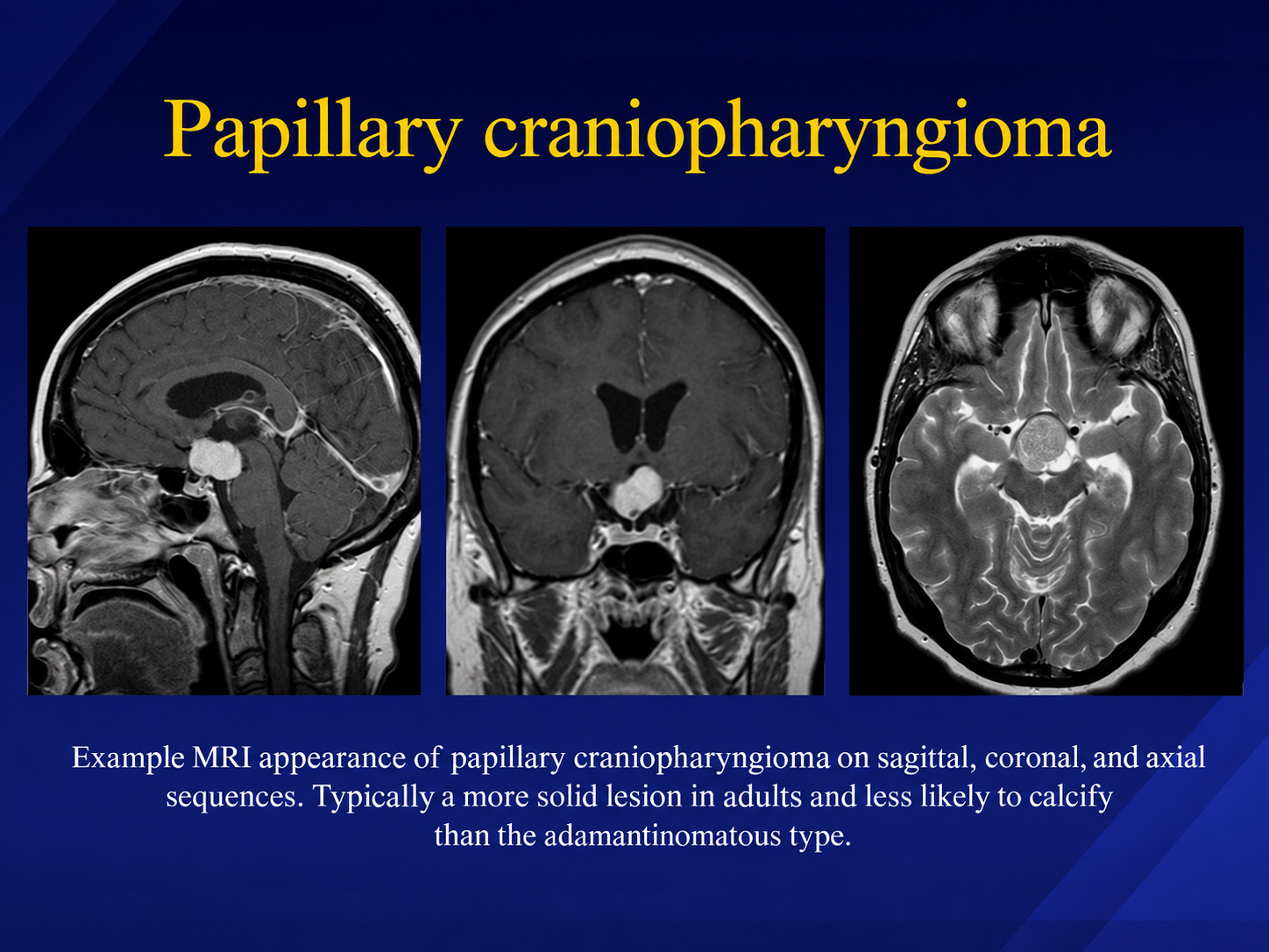 Sagittal coronal and axial MRI appearance of papillary craniopharyngioma