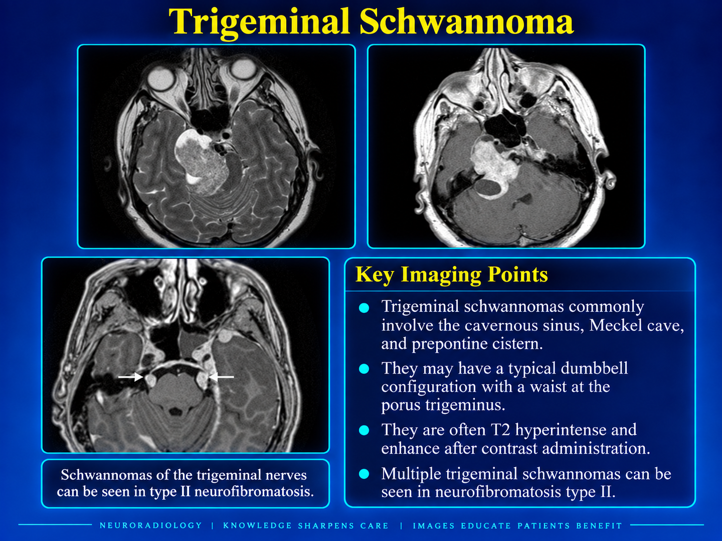 Trigeminal schwannoma involving the cavernous sinus Meckel cave and prepontine cistern