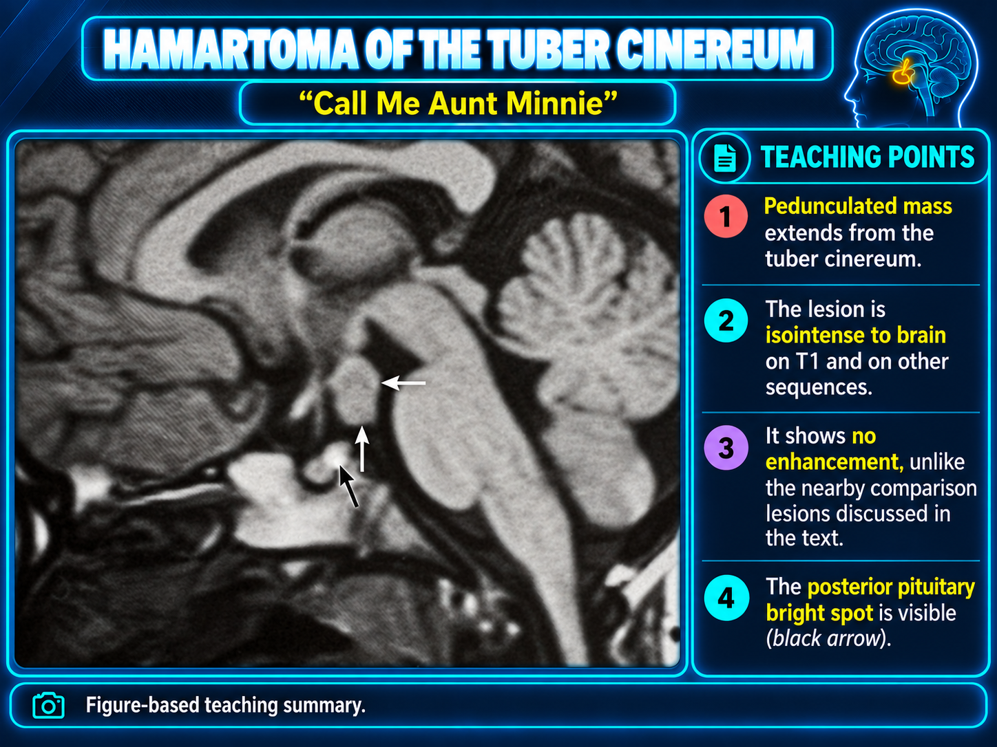 Pedunculated hamartoma arising from the tuber cinereum