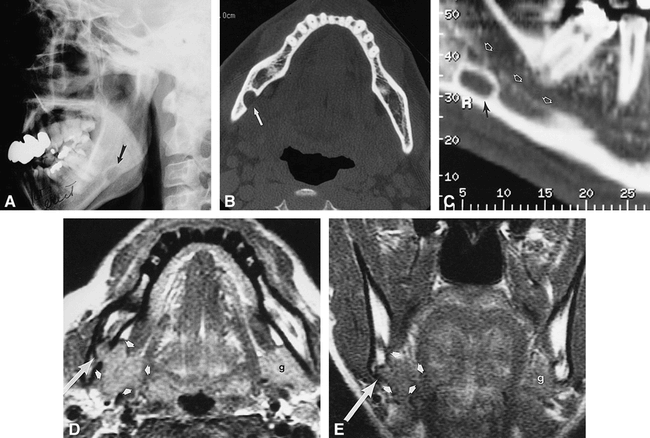 A, Lateral radiograph shows a radiolucent, ovoid, corticate lesion anterior to the right mandibular angle (arrow).

B, Dental CT scan, axial view, shows the radiolucency (arrow) to be a corticate defect on the lingual surface of the mandible.

C, On parasagittal curved reformatted image, the defect (black arrow) is seen to lie below the lower margin of the inferior alveolar canal (white arrows).

D, Axial proton density--weighted MR image (3300/17/1) shows that the mandibular defect (long arrow) contains soft tissue in continuity with, and isointense with, the submandibular salivary gland (short arrows). The contralateral gland (g) is marked for comparison.

E, Coronal T1-weighted MR image (600/16/1) again shows that the bony defect (long arrow) contains an extension of tissue from the submandibular gland (short arrows).