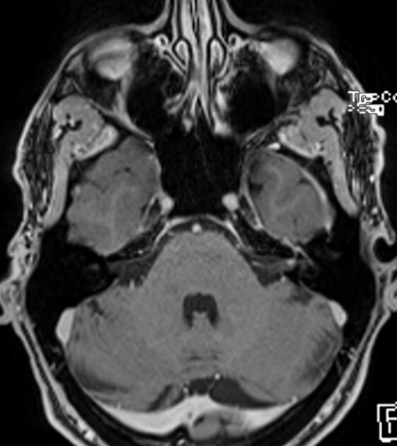 Lyme Disease (Left)