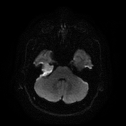 Petrous apex cholesteatoma
