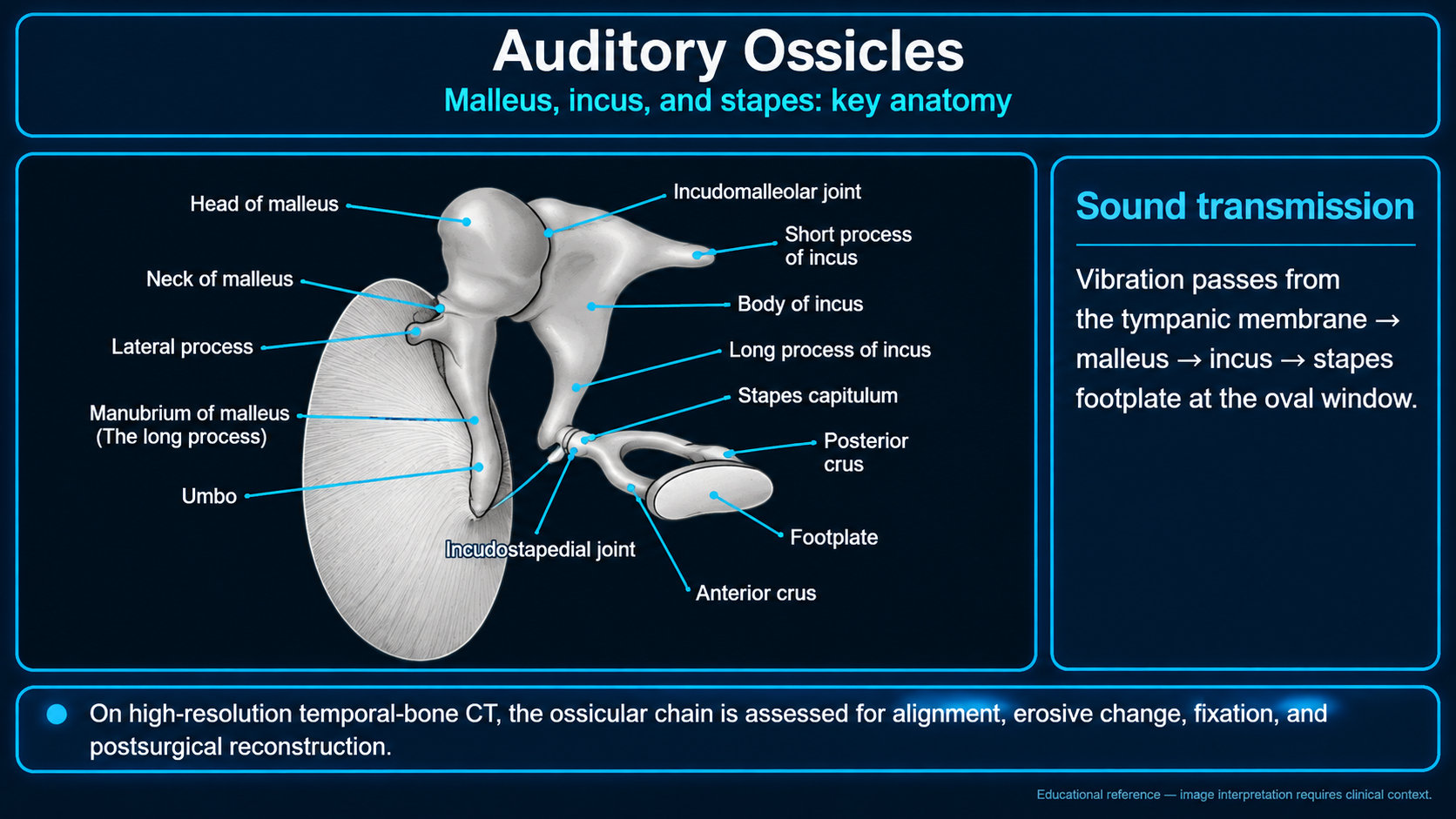 Labeled malleus, incus, and stapes anatomy