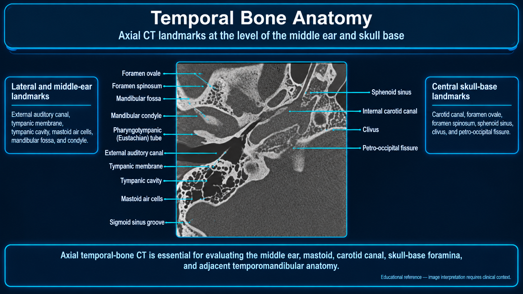 Labeled axial temporal-bone CT at the middle ear and skull base