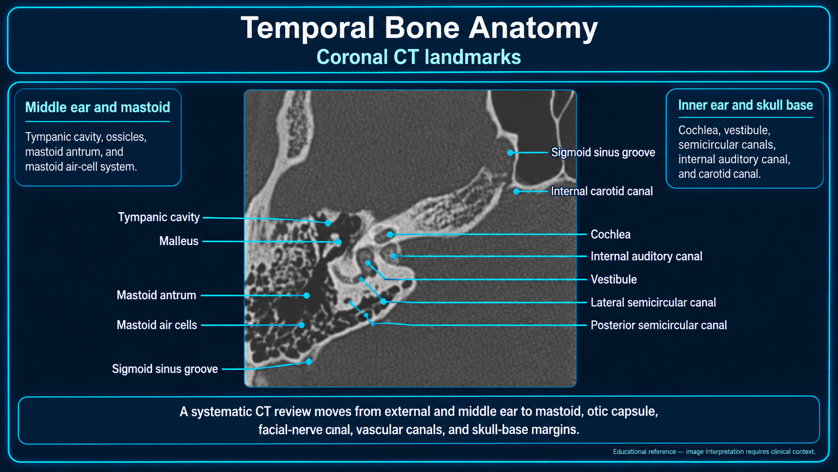 Labeled coronal temporal-bone CT landmarks