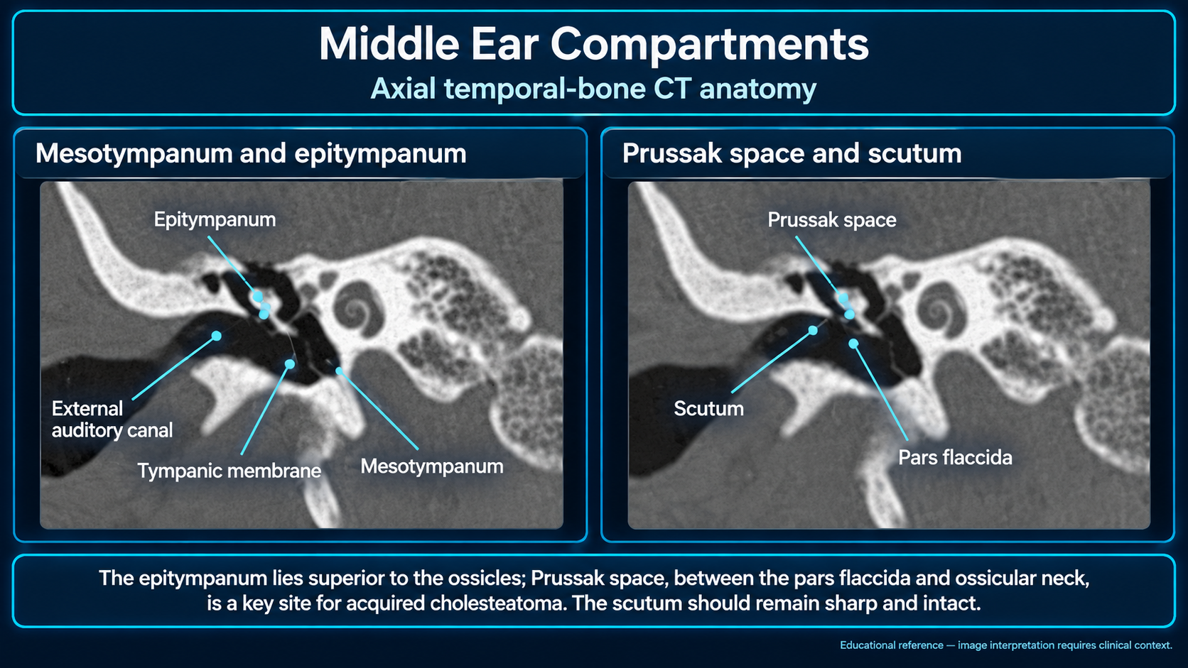 CT anatomy of the mesotympanum, epitympanum, Prussak space, and scutum