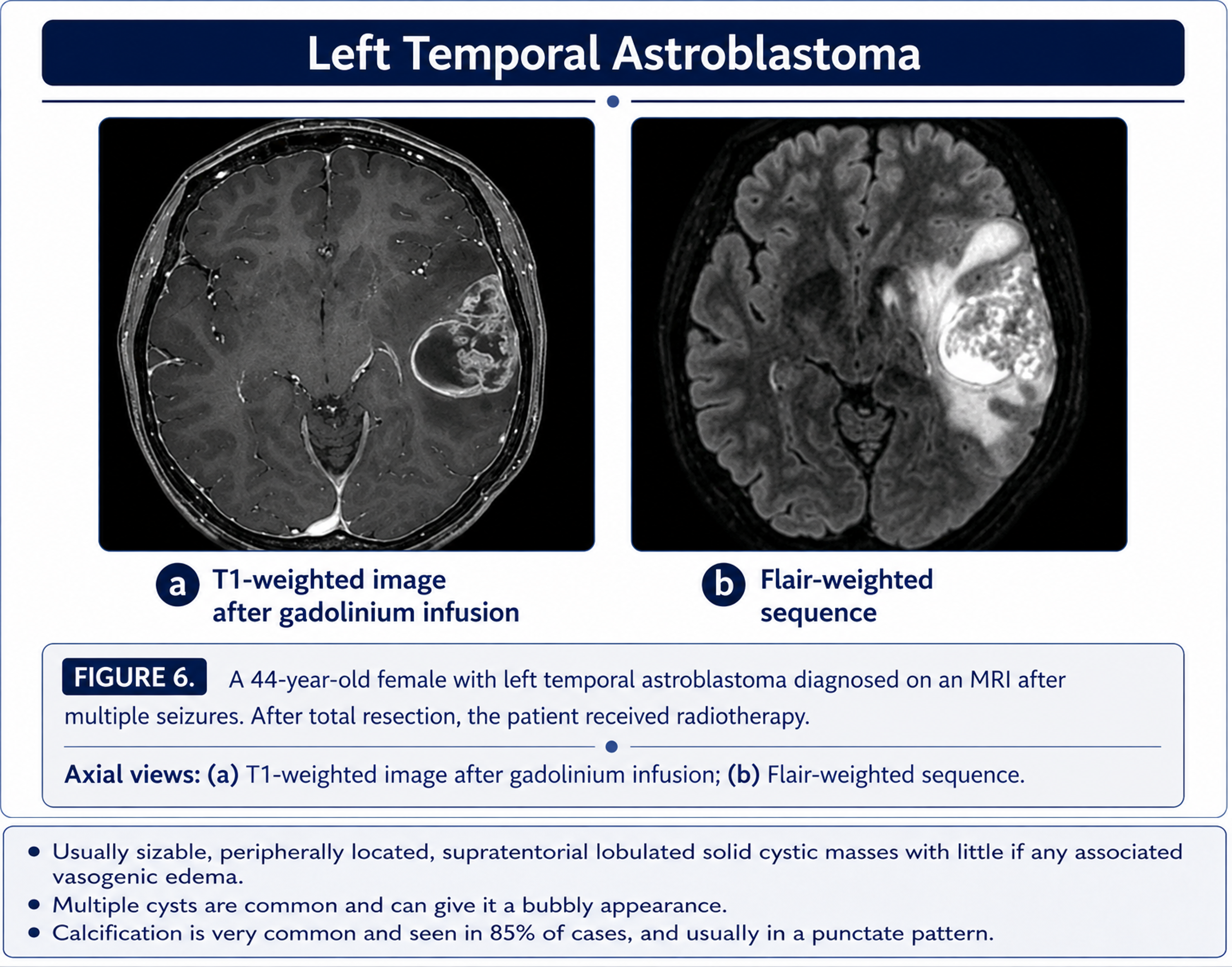 Left temporal astroblastoma